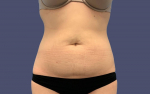 Abdominoplasty (Tummy Tuck) 6 Before